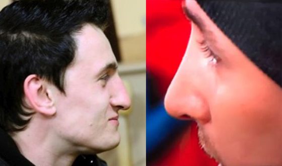 Влад Кадони сделал ринопластику: фото до и после операции