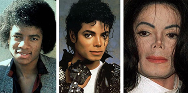 Пластические операции Майкла Джексона (до и после)