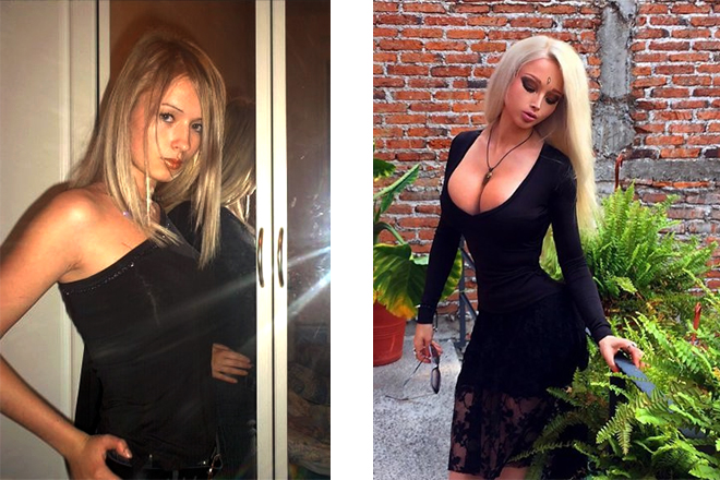 Валерия Лукьянова до и после операции