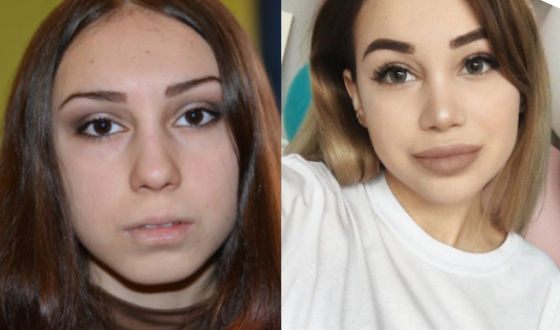 Милена Чижова до и после ринопластики